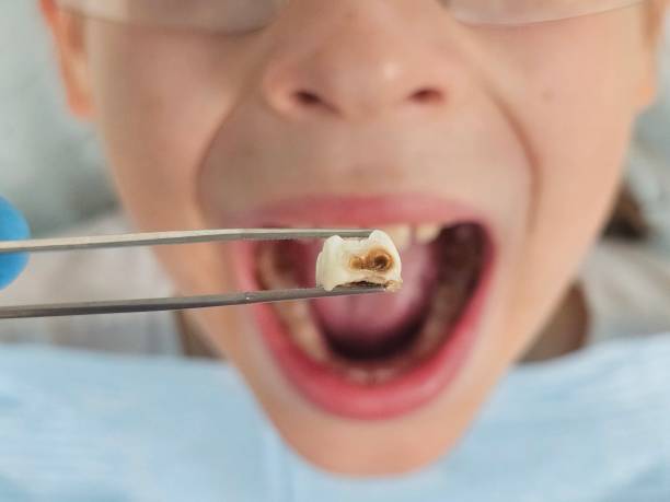 Best Chipped Tooth Repair Near Me  in Franklin, VA